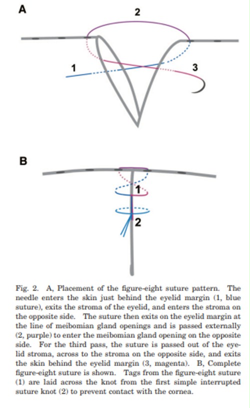Eyelid laceration repair